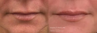 Lips Before & After Gallery - Patient 400676 - Image 1