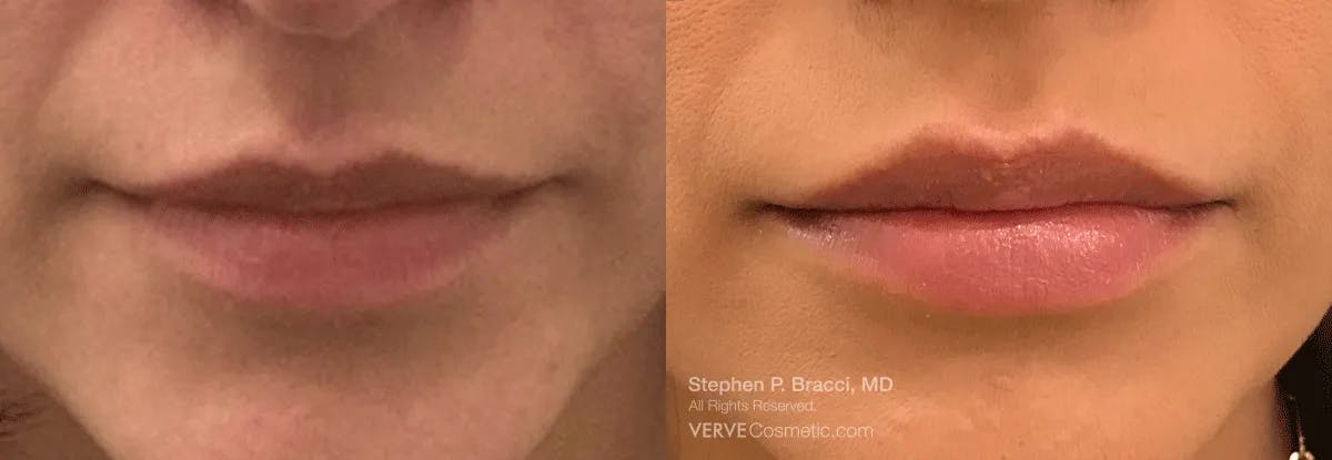 Lips Before & After Gallery - Patient 349650 - Image 1