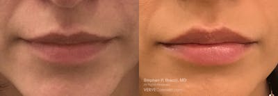 Lips Before & After Gallery - Patient 349650 - Image 1