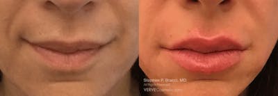 Lips Before & After Gallery - Patient 347739 - Image 1