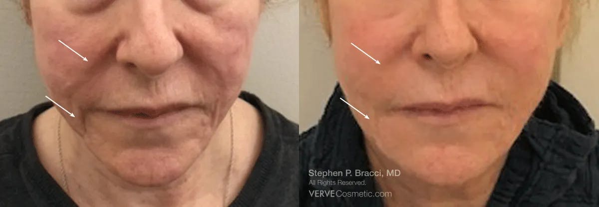 Nasolabial Folds & Marionette Lines Before & After Gallery - Patient 344683 - Image 1