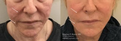 Nasolabial Folds & Marionette Lines Before & After Gallery - Patient 344683 - Image 1