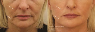 Nasolabial Folds & Marionette Lines Before & After Gallery - Patient 934620 - Image 1