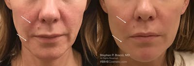 Nasolabial Folds & Marionette Lines Before & After Gallery - Patient 195501 - Image 1