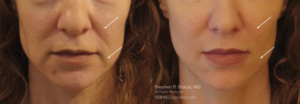 Nasolabial Folds & Marionette Lines Before & After Gallery - Patient 234096 - Image 1