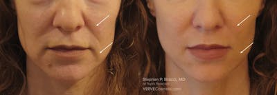 Nasolabial Folds & Marionette Lines Before & After Gallery - Patient 234096 - Image 1