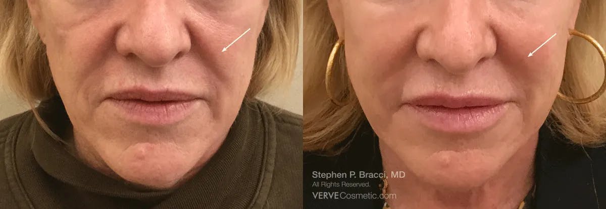 Nasolabial Folds & Marionette Lines Before & After Gallery - Patient 326369 - Image 1