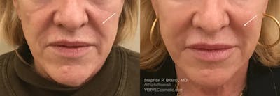 Nasolabial Folds & Marionette Lines Before & After Gallery - Patient 326369 - Image 1