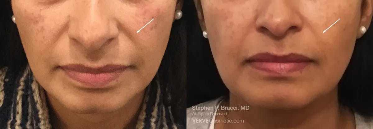Nasolabial Folds & Marionette Lines Before & After Gallery - Patient 396325 - Image 1