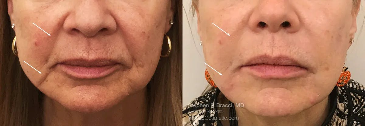 Nasolabial Folds & Marionette Lines Before & After Gallery - Patient 240978 - Image 1