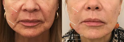 Nasolabial Folds & Marionette Lines Before & After Gallery - Patient 240978 - Image 1