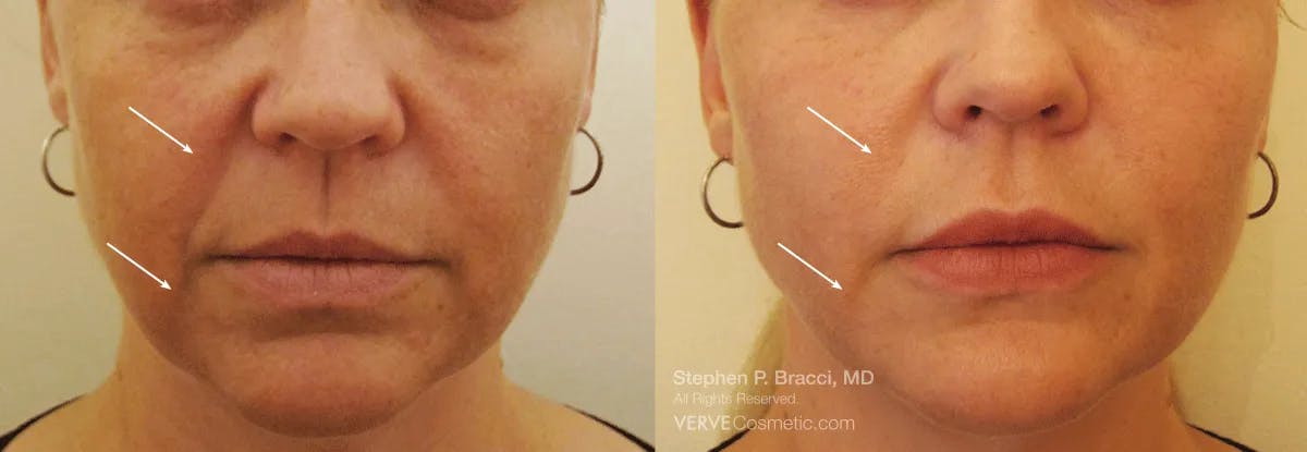 Nasolabial Folds & Marionette Lines Before & After Gallery - Patient 349740 - Image 1