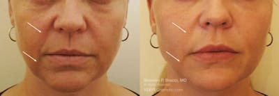 Nasolabial Folds & Marionette Lines Before & After Gallery - Patient 349740 - Image 1