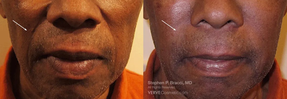 Nasolabial Folds & Marionette Lines Before & After Gallery - Patient 255559 - Image 1