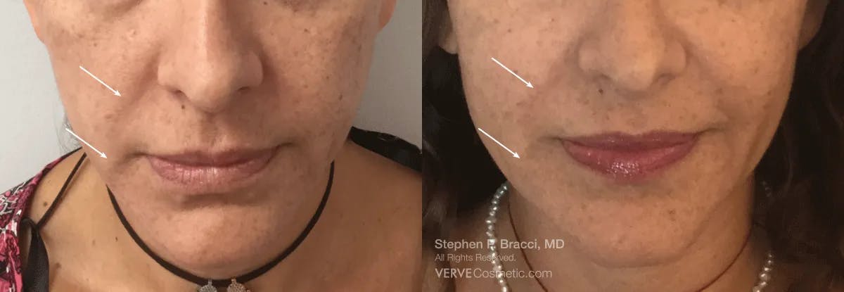 Nasolabial Folds & Marionette Lines Before & After Gallery - Patient 249823 - Image 1