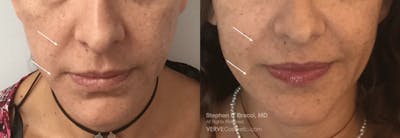 Nasolabial Folds & Marionette Lines Before & After Gallery - Patient 249823 - Image 1