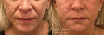 Nasolabial Folds & Marionette Lines Before & After Gallery - Patient 206119 - Image 1