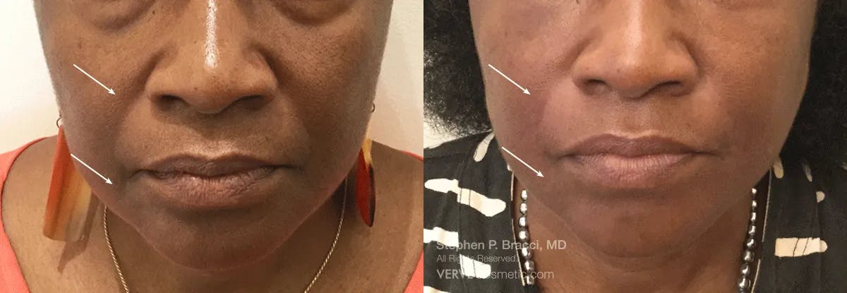 Nasolabial Folds & Marionette Lines Before & After Gallery - Patient 428763 - Image 1