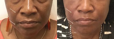 Nasolabial Folds & Marionette Lines Before & After Gallery - Patient 428763 - Image 1
