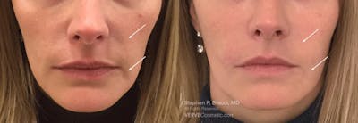 Nasolabial Folds & Marionette Lines Before & After Gallery - Patient 363433 - Image 1