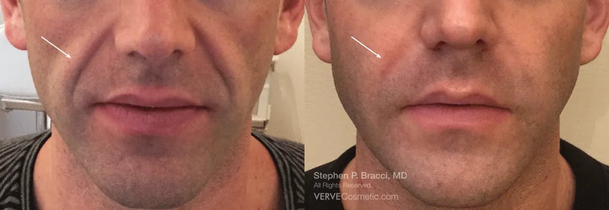 Nasolabial Folds & Marionette Lines Before & After Gallery - Patient 850948 - Image 1