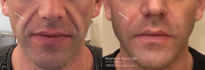 Nasolabial Folds & Marionette Lines Before & After Gallery - Patient 850948 - Image 1