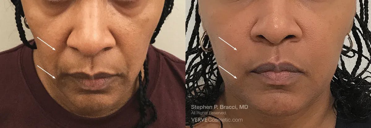 Nasolabial Folds & Marionette Lines Before & After Gallery - Patient 770672 - Image 1