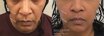 Nasolabial Folds & Marionette Lines Before & After Gallery - Patient 770672 - Image 1