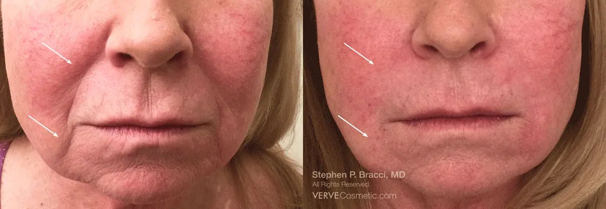 Nasolabial Folds & Marionette Lines Before & After Gallery - Patient 186759 - Image 1