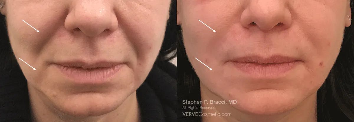 Nasolabial Folds & Marionette Lines Before & After Gallery - Patient 121731 - Image 1