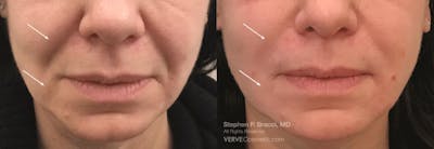 Nasolabial Folds & Marionette Lines Before & After Gallery - Patient 121731 - Image 1