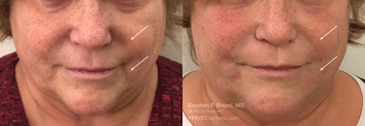 Nasolabial Folds & Marionette Lines Before & After Gallery - Patient 393271 - Image 1