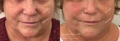 Nasolabial Folds & Marionette Lines Before & After Gallery - Patient 393271 - Image 1