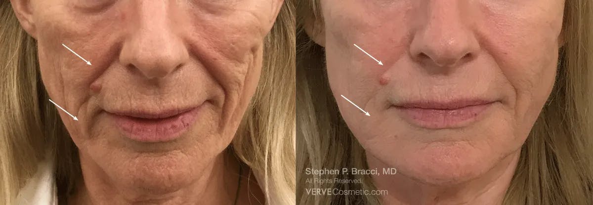 Nasolabial Folds & Marionette Lines Before & After Gallery - Patient 258931 - Image 1