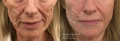 Nasolabial Folds & Marionette Lines Before & After Gallery - Patient 258931 - Image 1