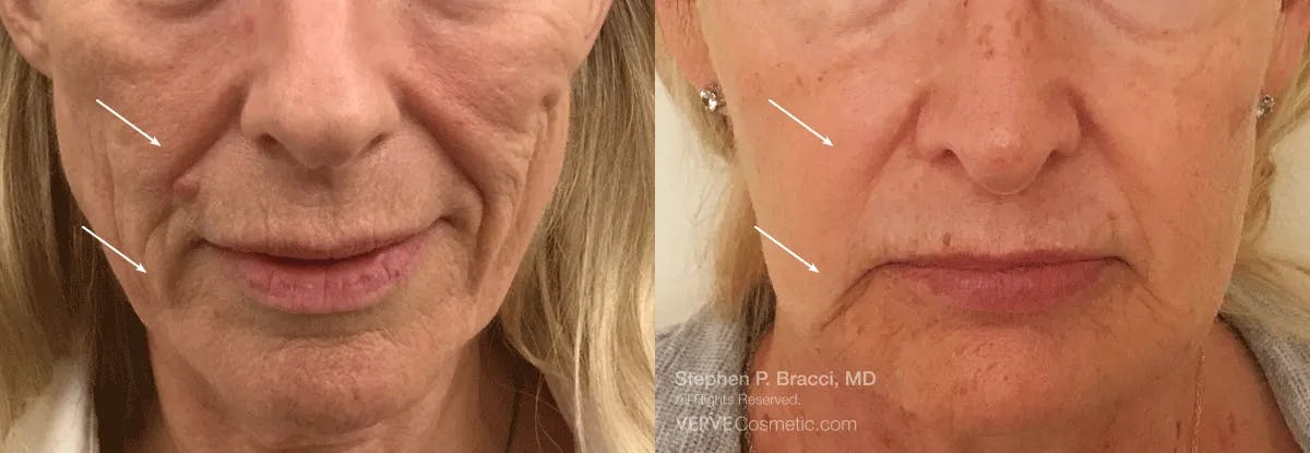 Nasolabial Folds & Marionette Lines Before & After Gallery - Patient 201642 - Image 1