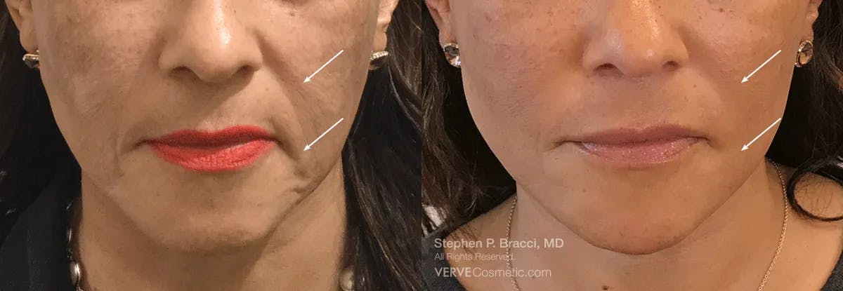 Nasolabial Folds & Marionette Lines Before & After Gallery - Patient 290669 - Image 1