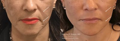 Nasolabial Folds & Marionette Lines Before & After Gallery - Patient 290669 - Image 1