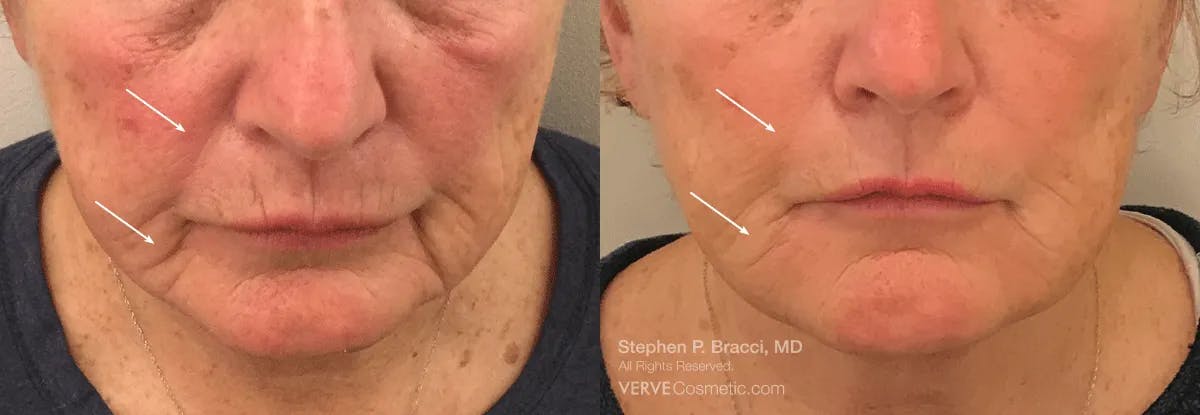 Nasolabial Folds & Marionette Lines Before & After Gallery - Patient 416900 - Image 1