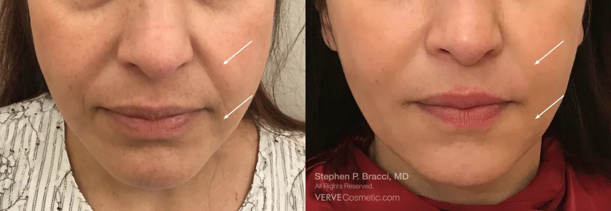 Nasolabial Folds & Marionette Lines Before & After Gallery - Patient 314427 - Image 1