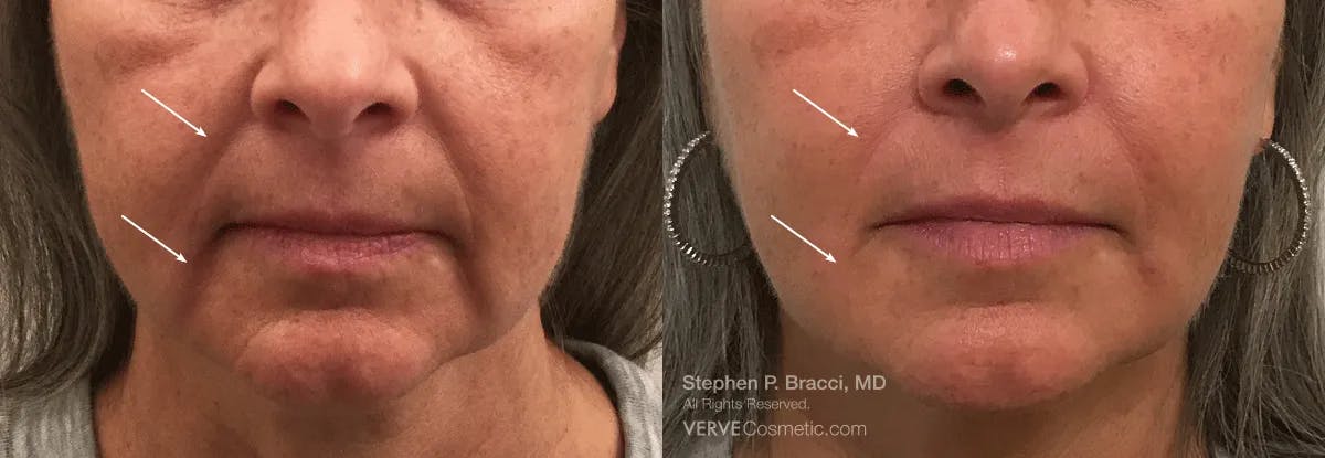 Nasolabial Folds & Marionette Lines Before & After Gallery - Patient 910228 - Image 1