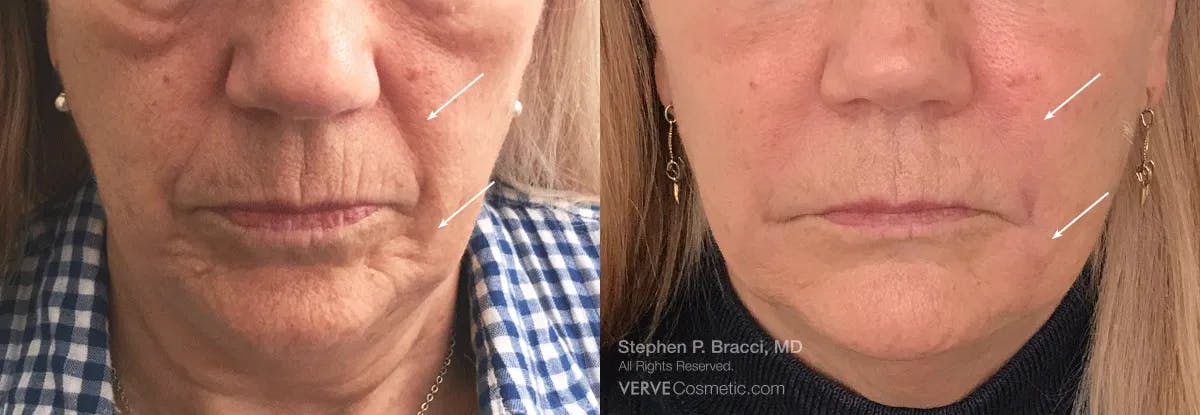 Nasolabial Folds & Marionette Lines Before & After Gallery - Patient 602825 - Image 1