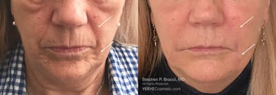 Nasolabial Folds & Marionette Lines Before & After Gallery - Patient 602825 - Image 1