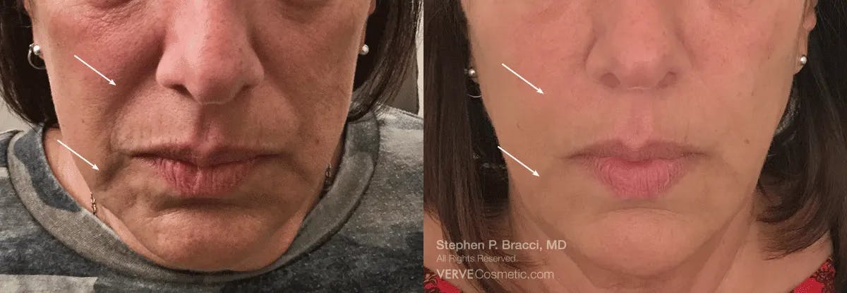 Nasolabial Folds & Marionette Lines Before & After Gallery - Patient 306164 - Image 1