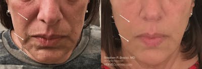 Nasolabial Folds & Marionette Lines Before & After Gallery - Patient 306164 - Image 1