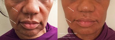 Nasolabial Folds & Marionette Lines Before & After Gallery - Patient 399491 - Image 1