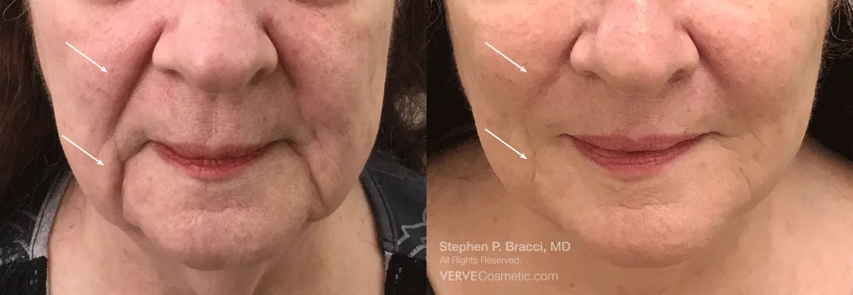 Nasolabial Folds & Marionette Lines Before & After Gallery - Patient 137435 - Image 1