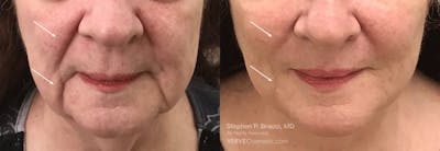 Nasolabial Folds & Marionette Lines Before & After Gallery - Patient 137435 - Image 1