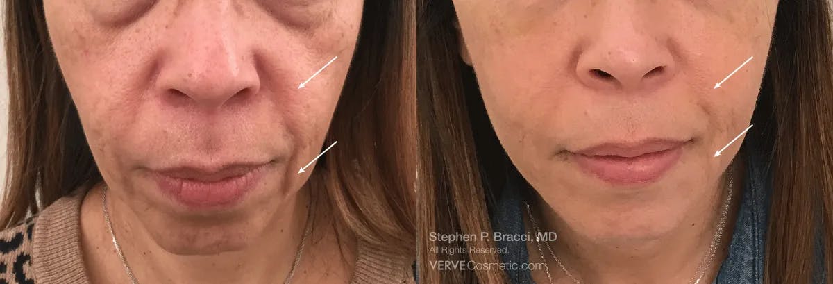 Nasolabial Folds & Marionette Lines Before & After Gallery - Patient 961107 - Image 1
