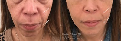 Nasolabial Folds & Marionette Lines Before & After Gallery - Patient 961107 - Image 1